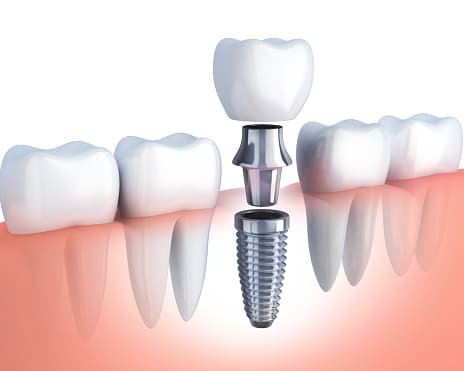 South Barrington IL Dentist
